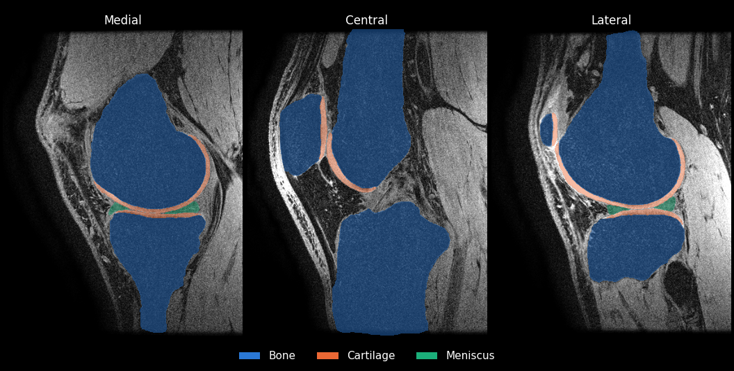 The same three sagittal slices with the OpenMSK segmentation drawn on top
                          as a semi-transparent tint: bone in blue covering the femur, tibia and
                          patella; cartilage in orange as a thin curved band along each bone
                          surface; and meniscus in green as small wedges between the femur and
                          tibia in the medial and lateral slices.