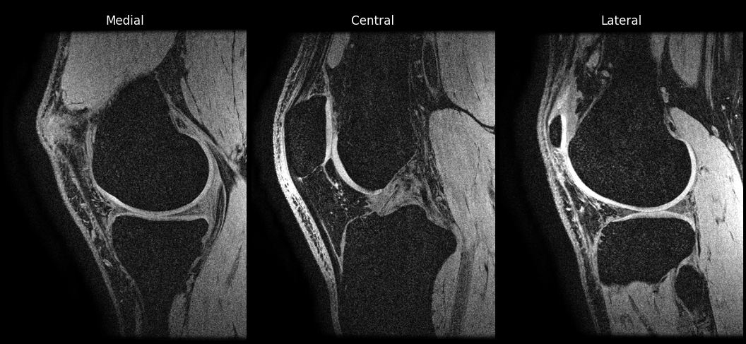 Three sagittal slices through the example knee, shown left to right from
                          the medial side to the lateral side. Each slice is displayed with the
                          front of the knee on the left and the top of the knee at the top. The
                          cartilage lining the femur and tibia is bright against dark bone marrow,
                          and the whole joint — femur, tibia, patella and the surrounding soft
                          tissue — is inside the field of view.
